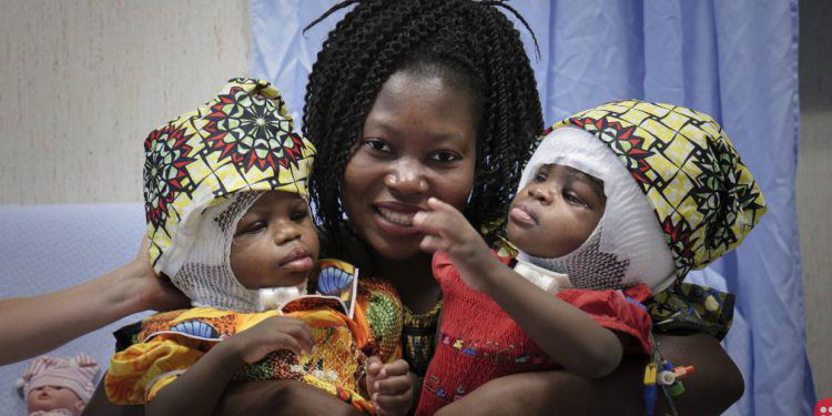Conjoined twin girls joined at the skull separated successfully in rare surgery in Italy